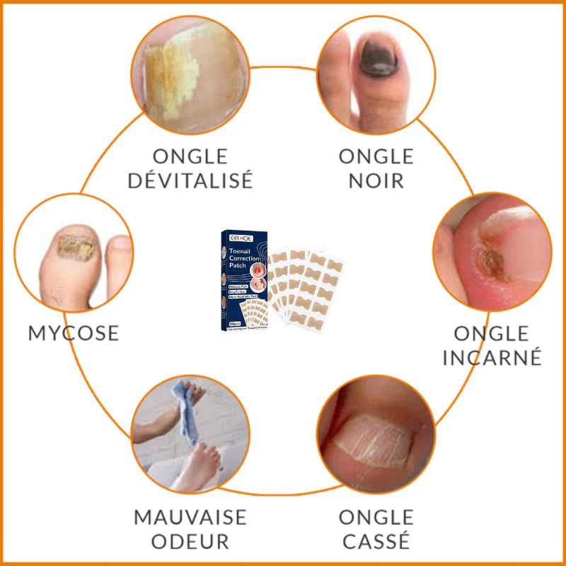 Patchs Correcteurs d'Ongles Incarnés